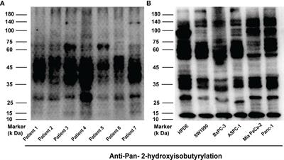 Global landscape of 2-hydroxyisobutyrylation in human pancreatic cancer